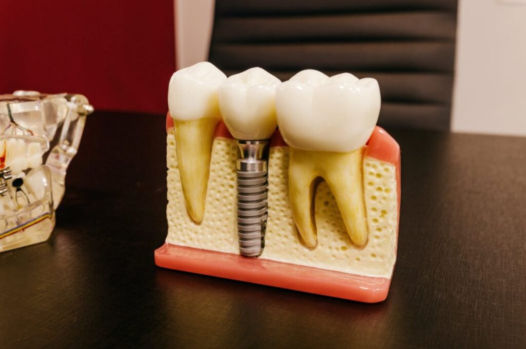 dental implants with screw on table in clinic · fr