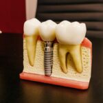 dental implants with screw on table in clinic · fr